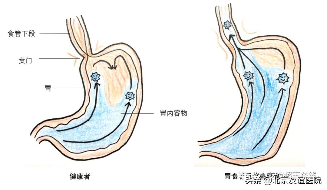 中医治疗胃食管反流病靠谱吗,胃食管反流病北京医院
