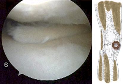 半月板三度撕裂该如何保守治疗,半月板三度撕裂还可以保守治疗吗