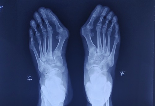 小脚趾磨出茧是因为拇外翻吗,怎么知道脚底长的是茧还是疣