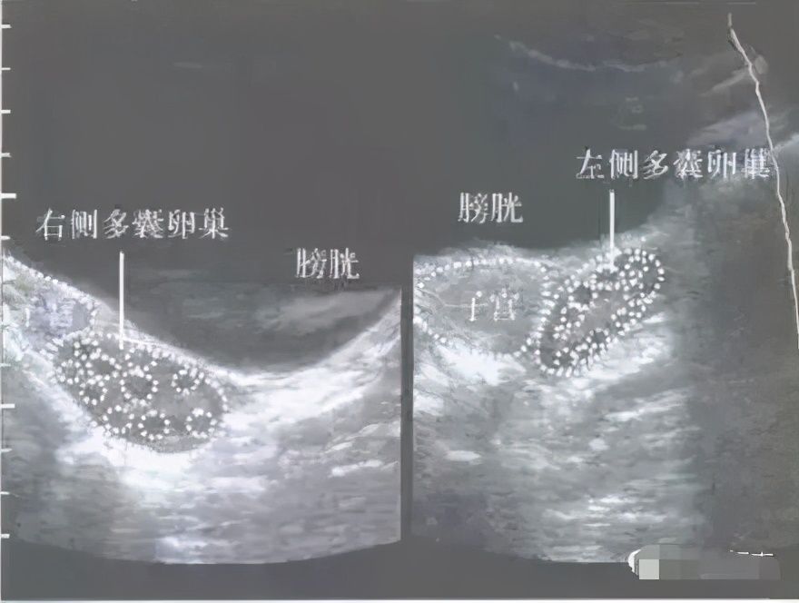 b超显示卵泡多就是多囊卵巢么,卵巢内有10-12个卵泡算多囊吗