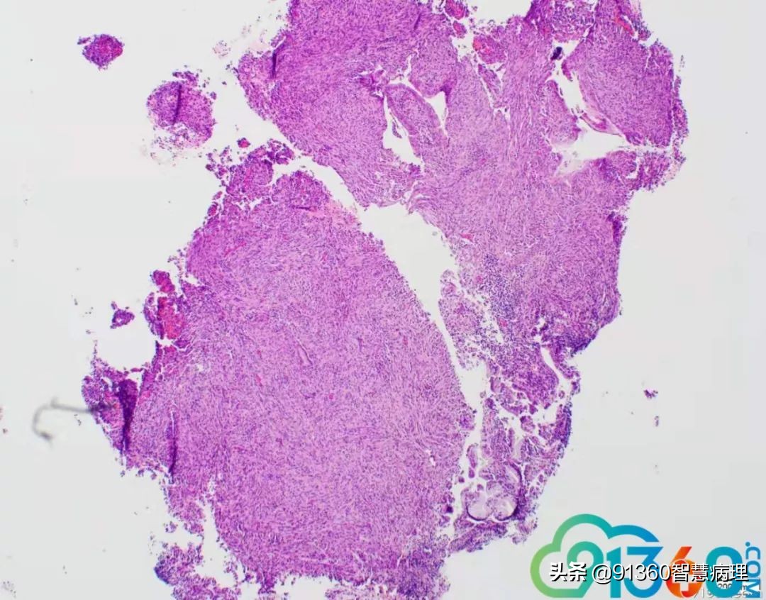 宫颈腺癌silvaa型严重吗,宫颈腺癌silvab型复发率高吗