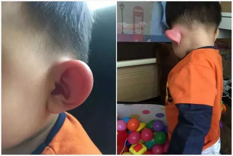 被蚊子咬了什么症状是得病了,被蚊子咬了出现的症状和解决方法