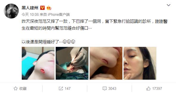 范玮琪下巴缝15针照片,范玮琪晒素颜照皮肤焦黄显憔悴