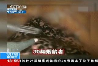 戒烟后变黑的肺能恢复吗,戒烟之后变黑的肺还能白回来吗