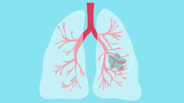 肺癌5年复发化疗方案,肺癌四期成功案例