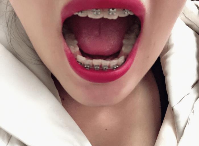 牙套隐形日记,牙套日记正颌