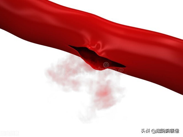 脑动脉瘤破裂后昏迷开颅,颅内动脉瘤破裂出血昏迷不醒