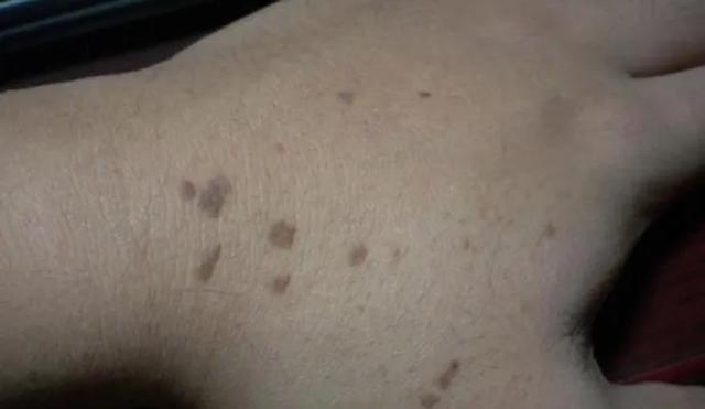 得了乙肝的人身上长红点怎么回事,乙肝病毒携带者身上有一颗颗红点