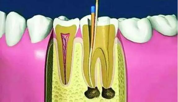 杀神经根管治疗的费用,杀神经根管治疗后可以直接补牙吗