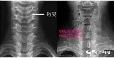 肘关节x线解剖,颈椎x线图片与讲解大全