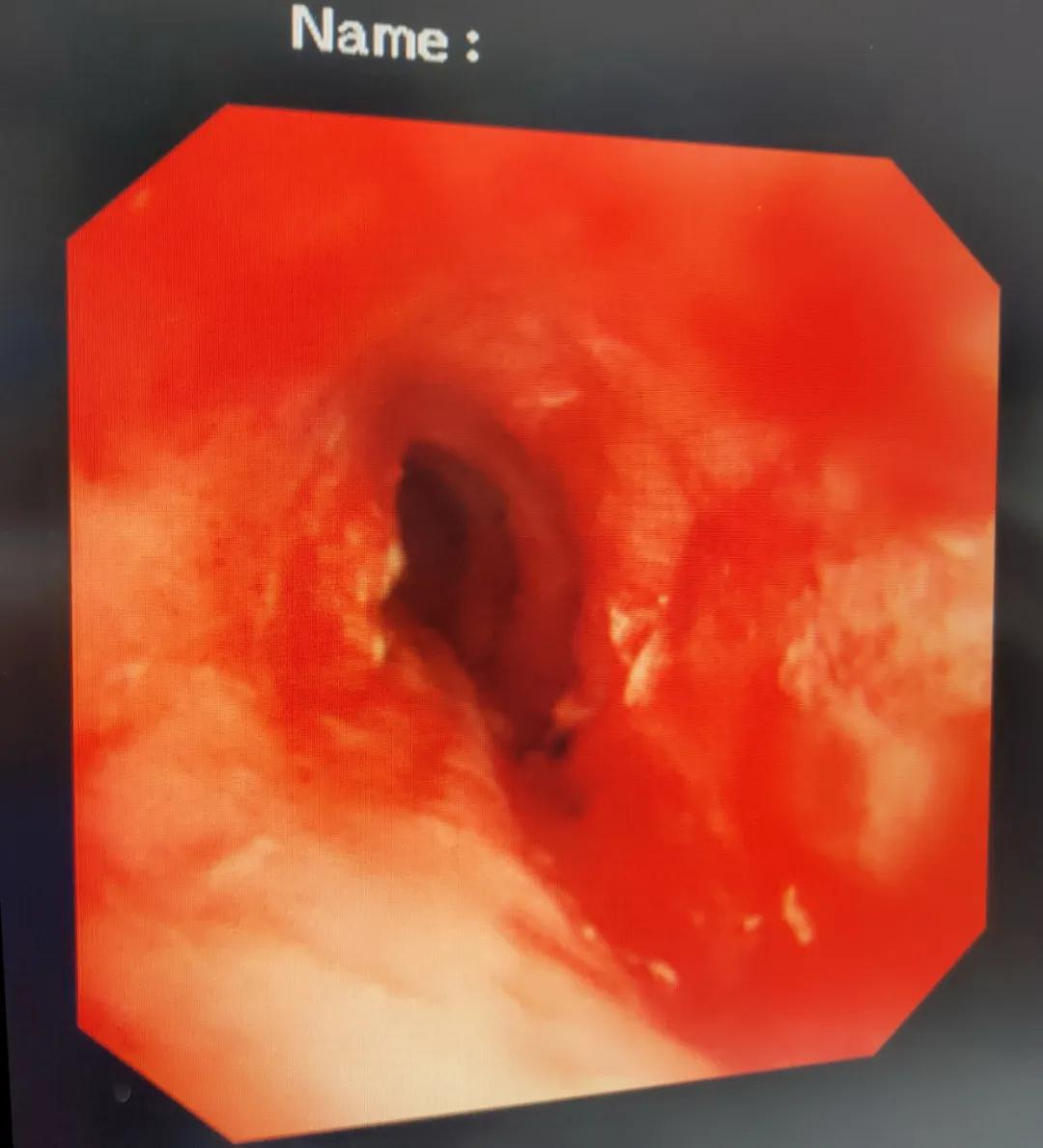 鱼刺卡住吞饭更严重示意图,鱼刺卡喉吃馒头咽下去了会怎样