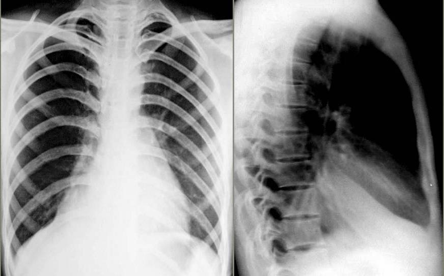 x线诊断边界模糊,x线诊断有误区吗