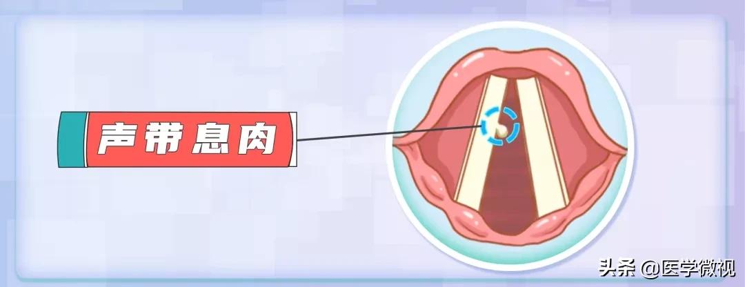 声音嘶哑是声带出了问题吗,声音嘶哑好几个月了怎么治
