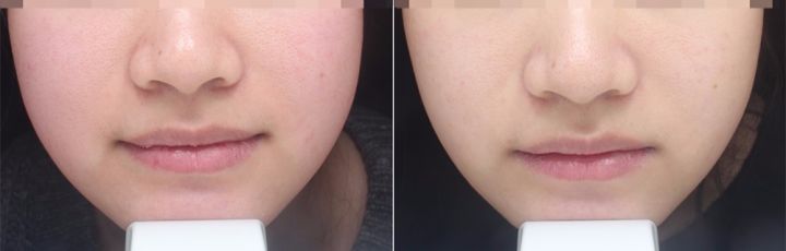 换季皮肤干燥过敏怎么补水保湿,换季皮肤过敏怎么办