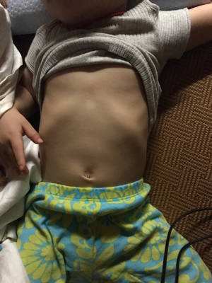 十个月宝宝肋骨外翻正常吗,生宝宝后肋骨外翻怎么矫正