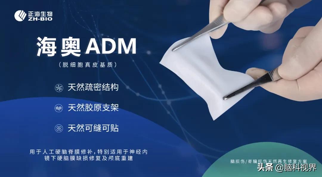 张洪钿神经外科,张洪钿做听神经瘤