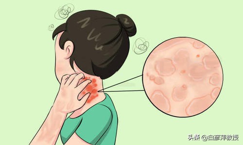 什么叫荨麻疹荨麻疹是怎么引起的,荨麻疹的类型都有哪几种