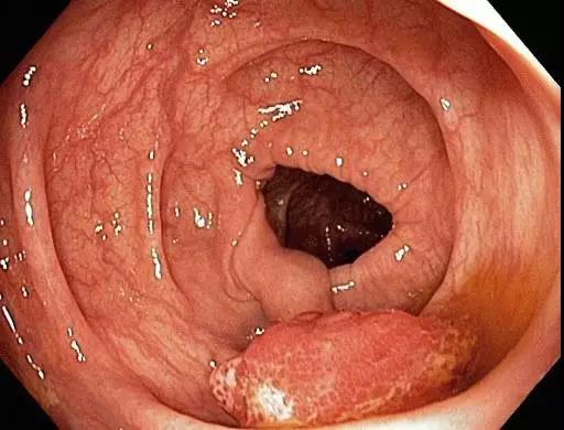 有肠息肉大便时有什么症状,除了痔疮出血还有什么会出血