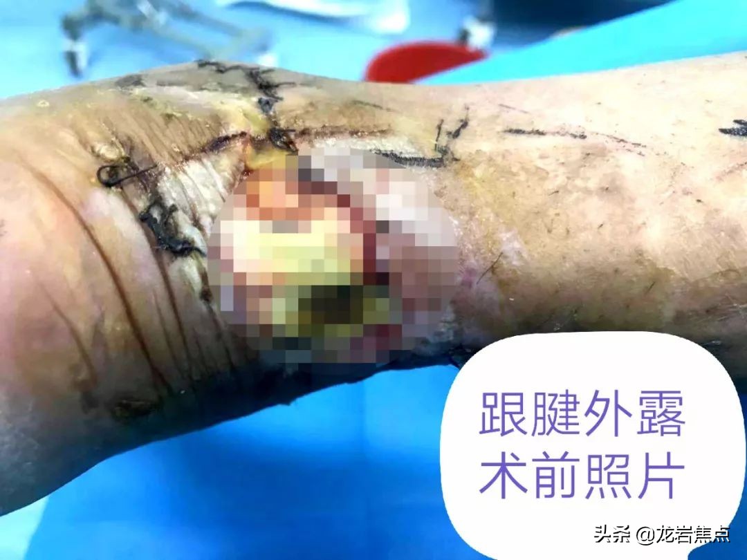 整块皮没了怎么处理,整块皮肤没了会增生吗