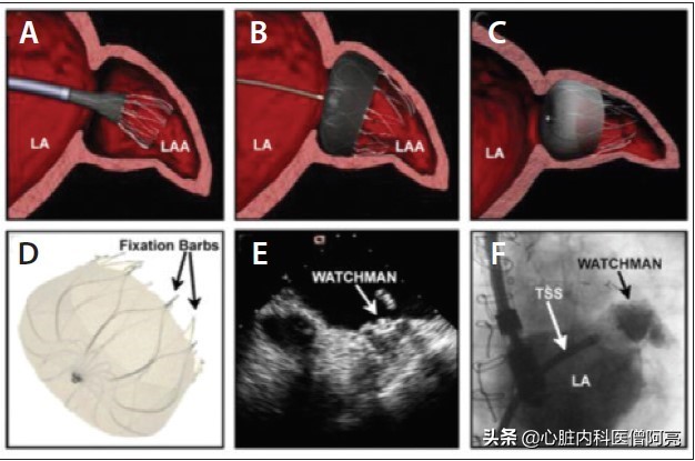 心脏有血栓能做房颤消融术吗,心脏房颤导致脑栓塞怎么治疗