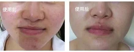 抗痘抑菌凝胶,祥顺比尔霍夫抑菌凝胶治理皮癣