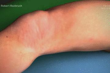 手术的时候医生对你做了什么,手术时切了一片肺叶