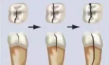 明明没有经常吃甜食牙却蛀了,明明牙齿没有虫但是很痛