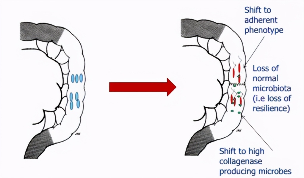 大肠癌切除后腹胀,大肠癌腹痛是牵扯疼吗