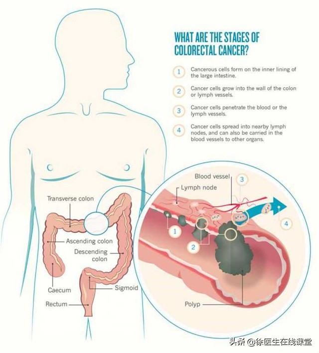 从炎症到癌症，一般需要多长时间？医生：3种炎症，尽量不要拖