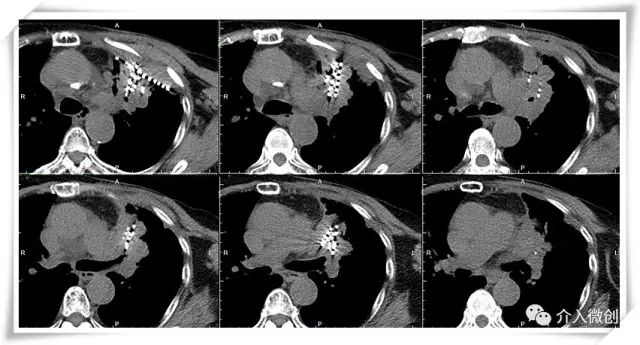 肺转移瘤消融能达到根治效果吗,肺转移瘤中医治疗