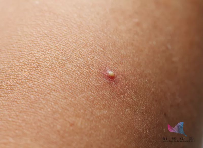 后背长小疙瘩的原因和解决方法,后背有疙瘩怎么去除