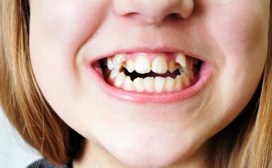 小朋友换牙歪歪扭扭,小孩换牙都长得歪歪扭扭怎么办