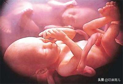 脐带脱垂对宝宝智商的影响,胎儿脐带扭转危害