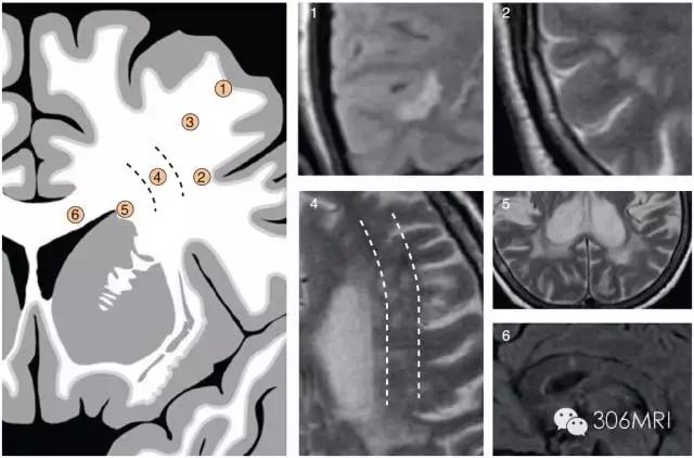 大脑深部白质区见斑点状异常信号,脑白质病变建议mri检查是什么意思