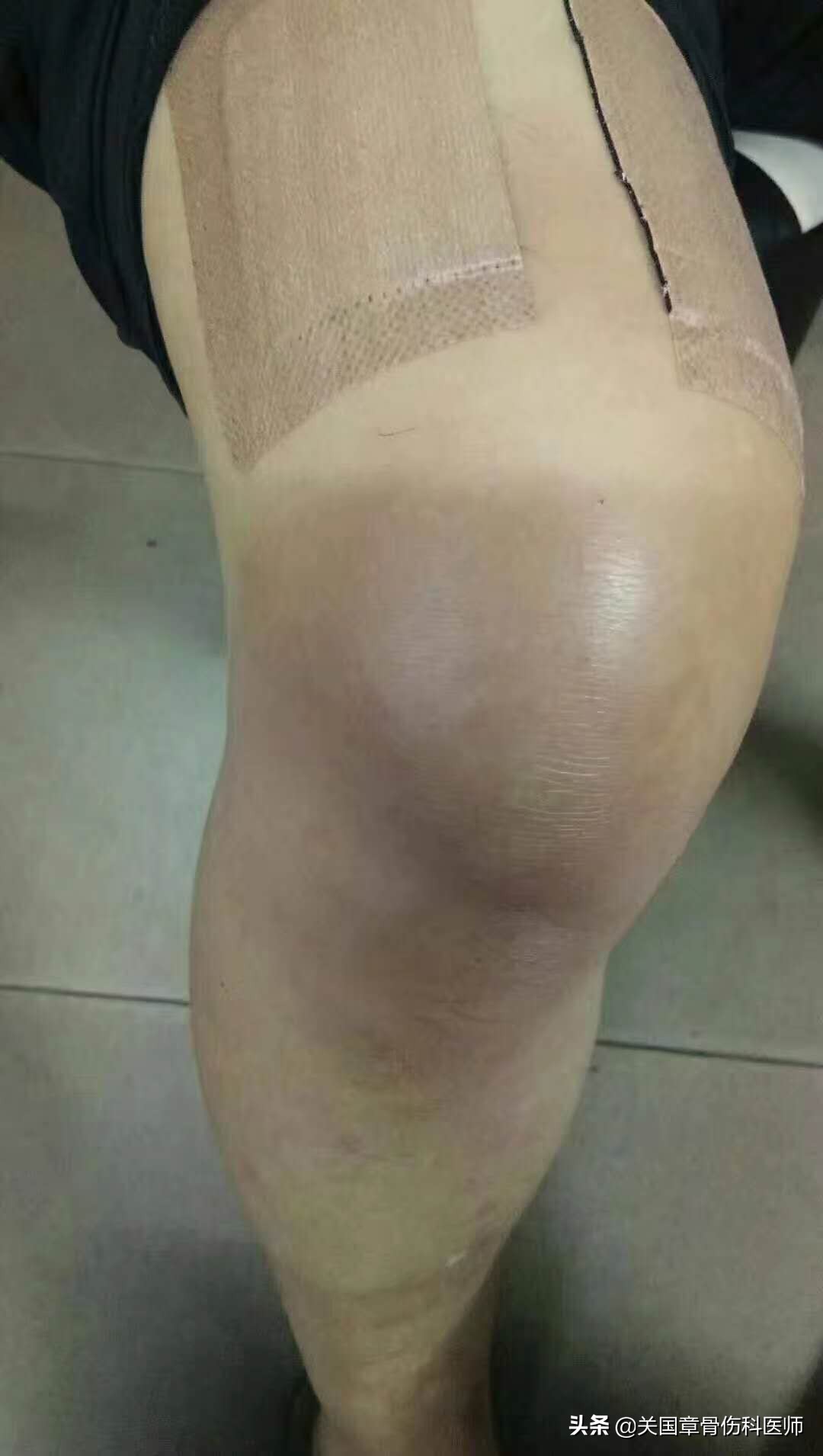 膝关节疼肿如何区分滑膜炎和感染,膝关节滑膜炎会引起哪些部位疼痛