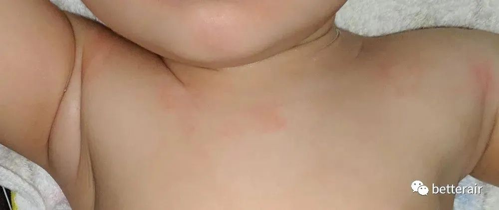 宝宝湿疹发作,痒痛到又哭又叫,直到betterair出现
