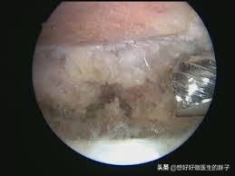 左肩疼痛是什么病的预兆,左肩疼痛要警惕什么病