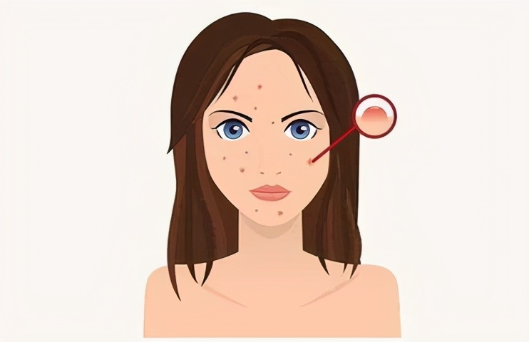 褐色的扁平疣治不好怎么办,鹤叔讲扁平疣最简单的去除方法