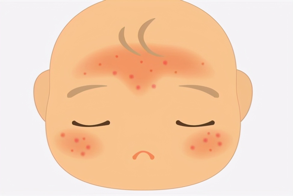 宝宝反复湿疹对付湿疹有妙招,战胜湿疹成功上岸