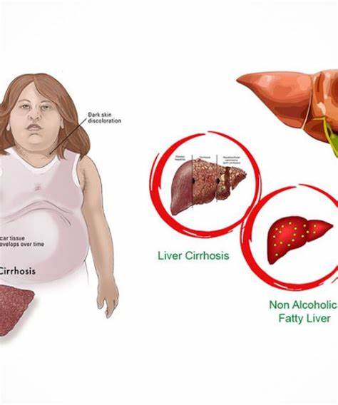 脂肪肝右肩膀痛是怎么回事,彩超显示脂肪肝但是有肝掌