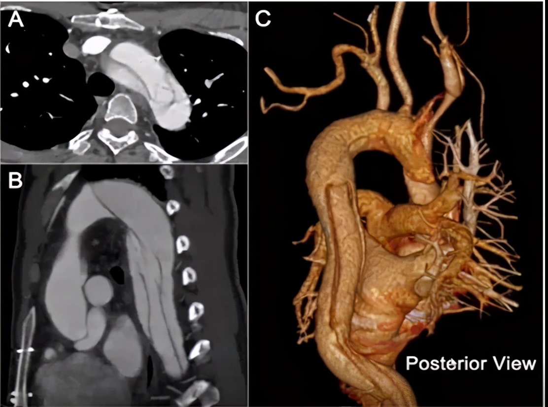 胡佳:升主动脉近端手术后新发弓部病变的腔内治疗