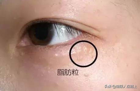 眼睛长期浮肿有严重的黑眼圈,冬天脸肿眼浮肿是什么原因