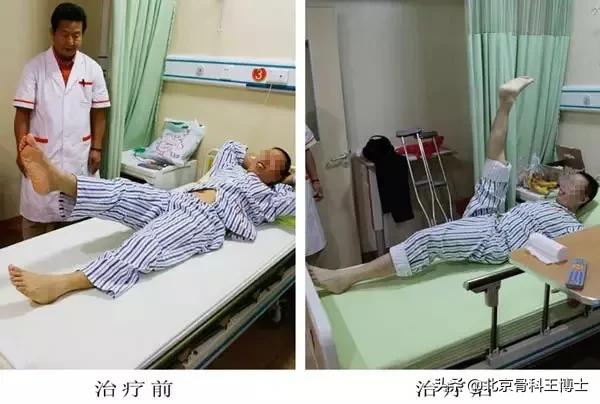 股骨头坏死,股骨头坏死前期锻炼能自愈吗