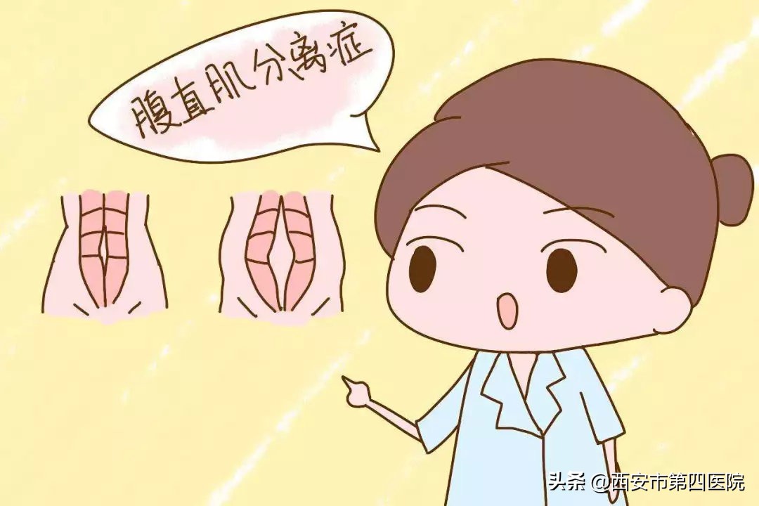 什么是腹直肌分离,腹直肌分离可以正骨修复吗