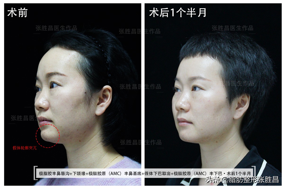 假体下巴手术亲身分享,做了假体下巴后成地包天