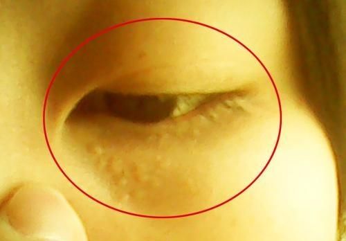 眼角脂肪粒怎么去除最简单方法,眼角的脂肪粒挤了好痛