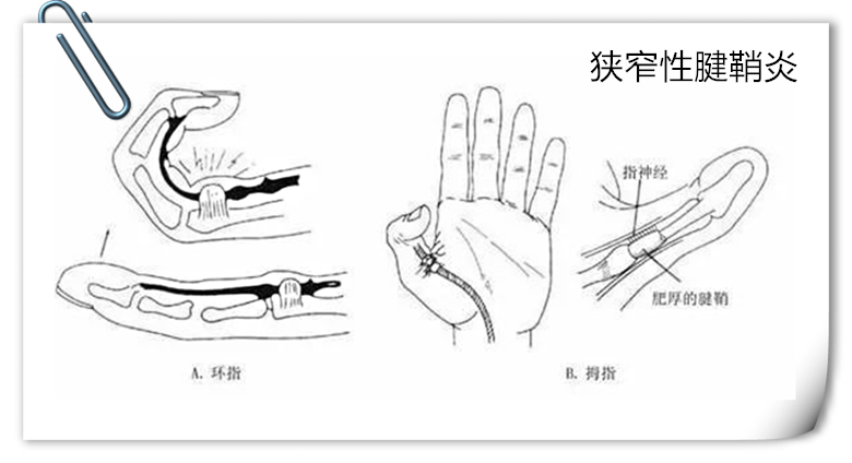 手指狭窄性腱鞘炎最快的恢复办法,手指狭窄性腱鞘炎怎么治疗小视频