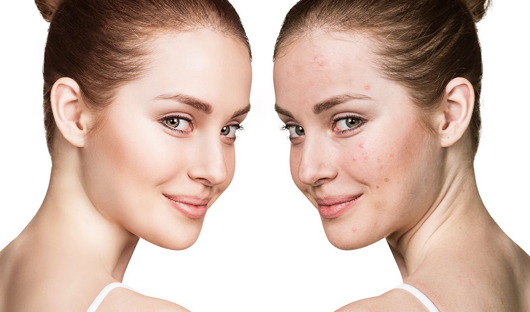 果酸换肤治疗痤疮原理,果酸换肤治疗痤疮