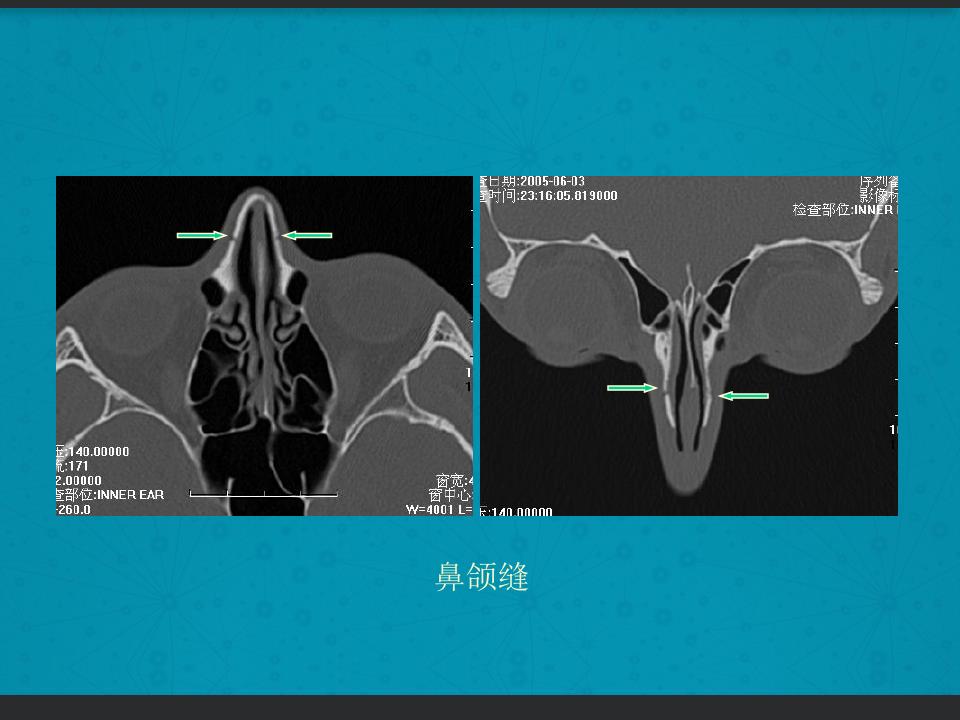 鼻骨骨折复位全过程,诊断证明鼻骨骨折问号是什么意思