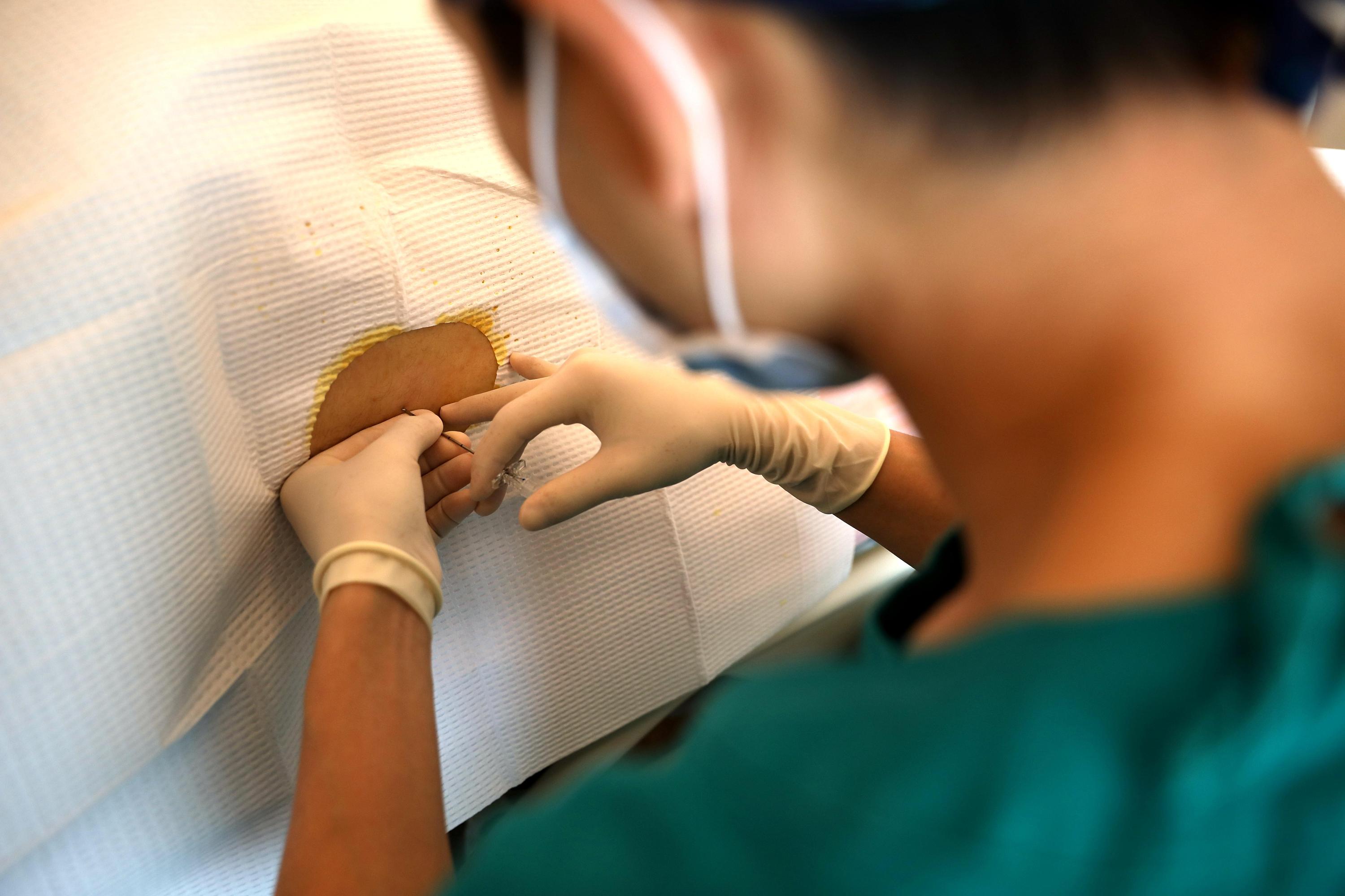 肛门狭窄的症状及治疗,肛门狭窄的症状及诊断标准